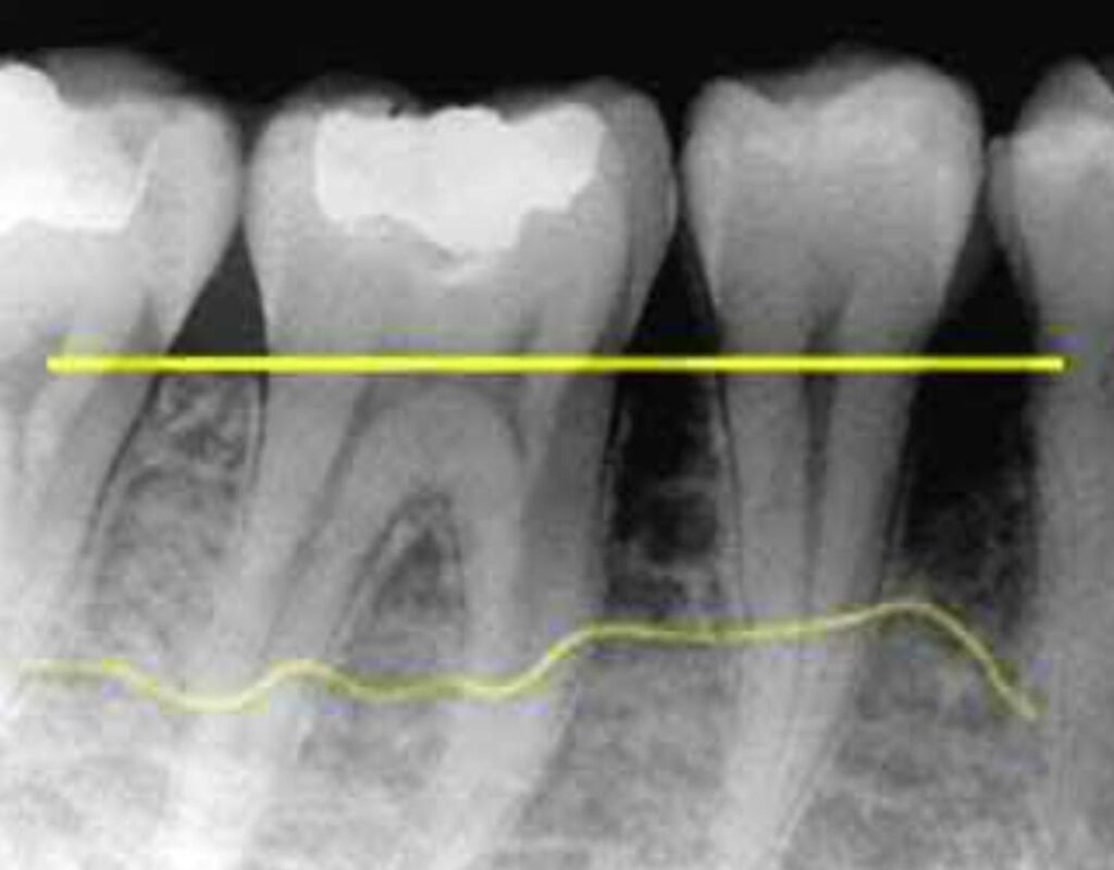Radiografía dental donde se observa la zona localizada de un diente con la encía retraída