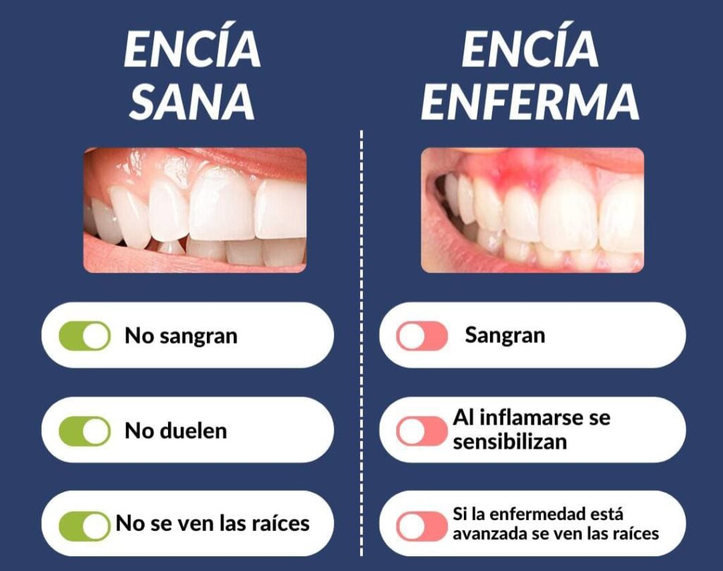 Encía sana donde se enumeran las características de una encía sana. Y lo mismo con una encía enferma