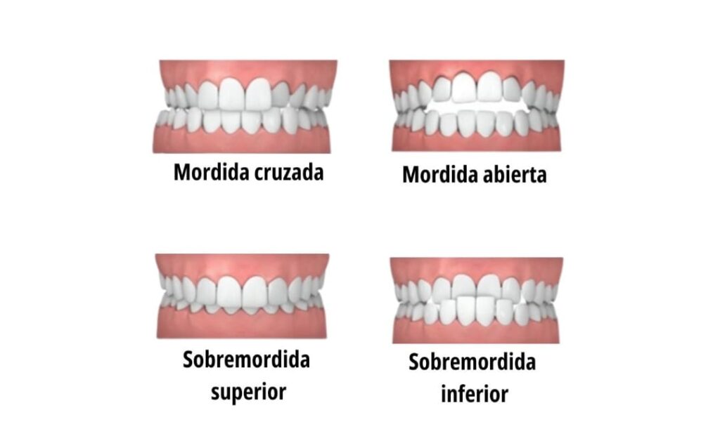 Comparación entre mordida normal y maloclusión dental