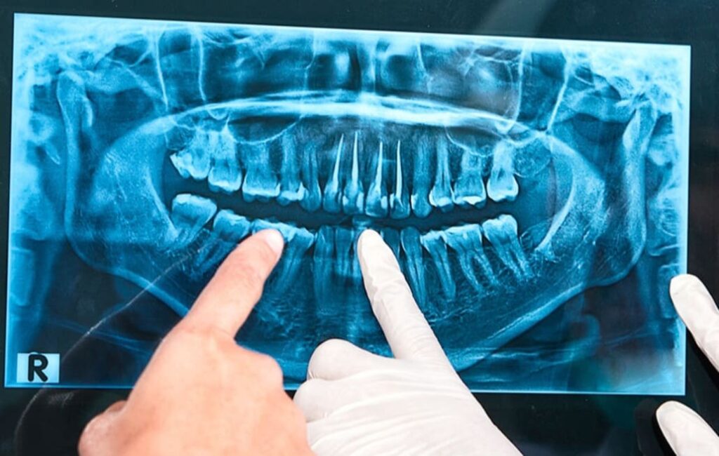 Radiografía dental para diagnóstico de movilidad dental