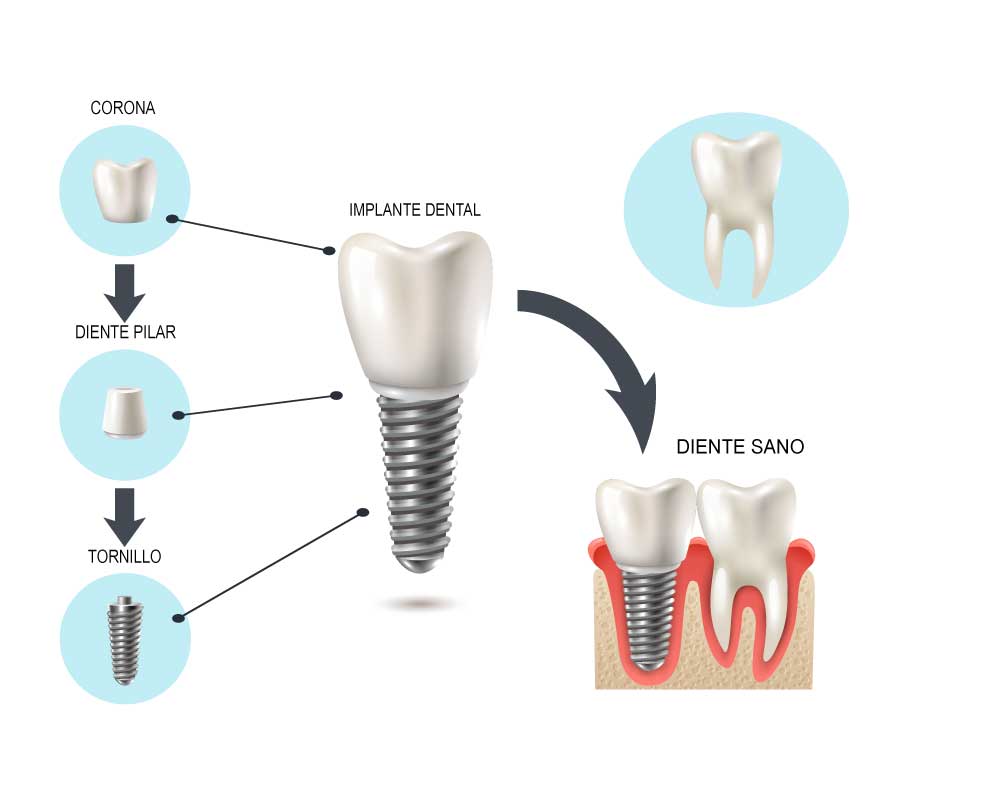 implantes dentales en Torrelavega
