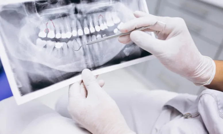 Implantes Dentales en Torrelavega: Recupera tu Sonrisa con Confianza 2 Una radiografía dental