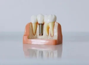 infografía de un implante dental