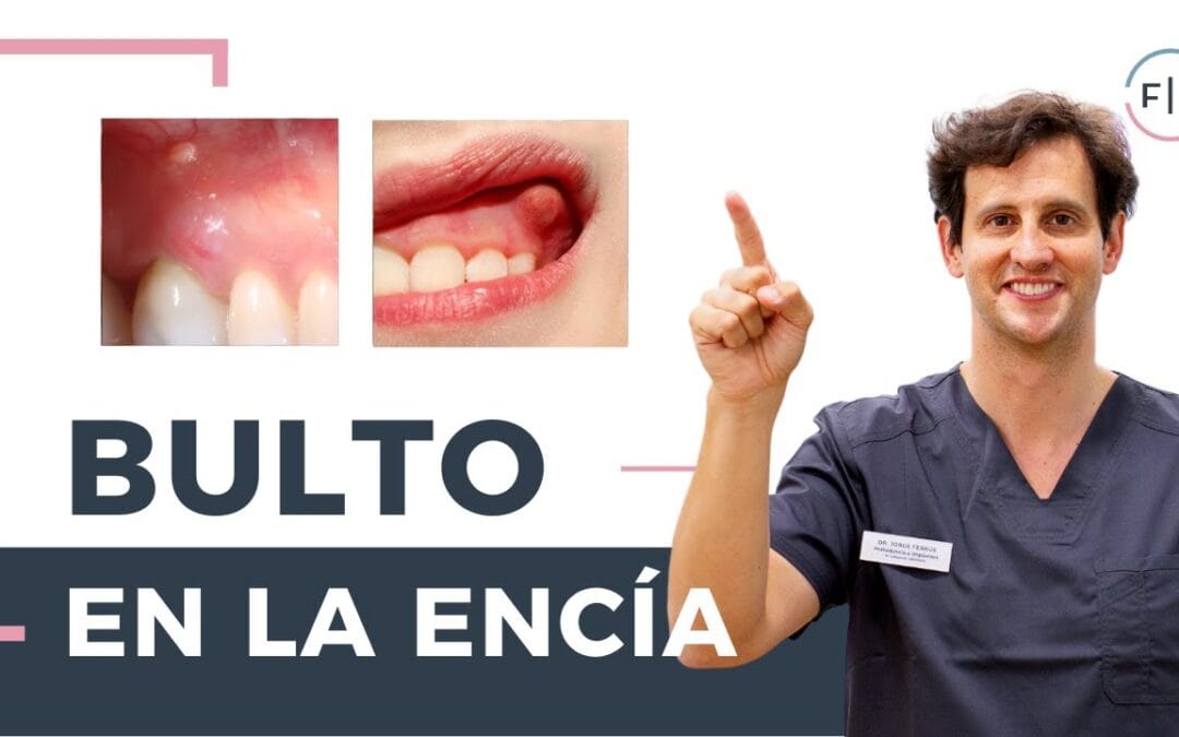 Tengo un “bulto blanco” en la encía: qué puede ser